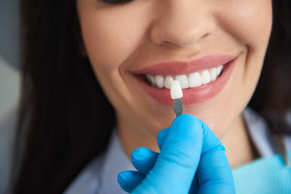 How To Care For Dental Veneers